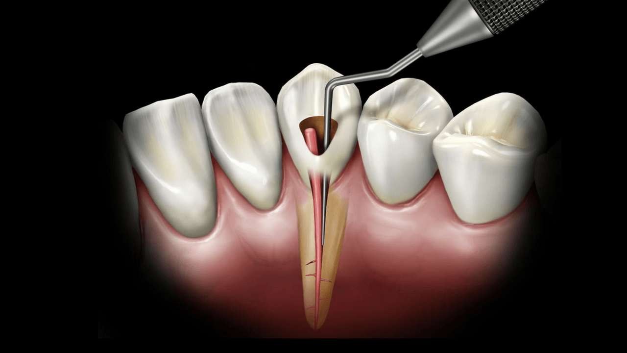 Rotary Endodontics Certificate Course in Hyderabad CDE Course,India